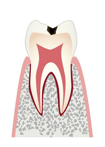 要観察歯からエナメル質限定の虫歯