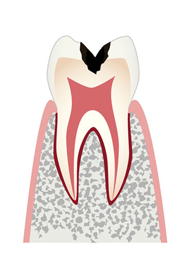 エナメル質から象牙質に及んだ虫歯