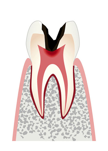 象牙質から歯髄に及んだ虫歯